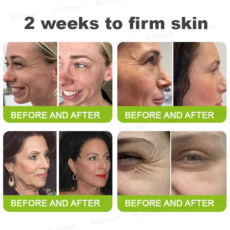 👨🏻‍⚕️ Made and shipped from the USA Rolimey® Botox & Vita-A Retinol Shot Wrinkle-Lift Tightening cream - Last Day Promotion 70% OFF