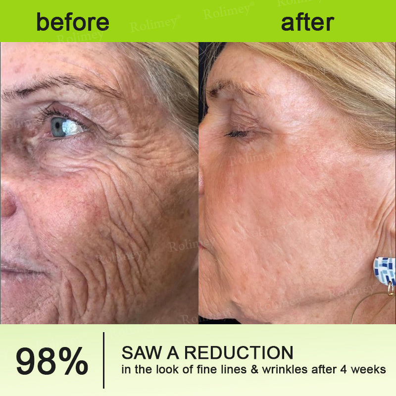 👨🏻‍⚕️ Made and shipped from the USA Rolimey® Botox & Vita-A Retinol Shot Wrinkle-Lift Tightening cream - Last Day Promotion 70% OFF
