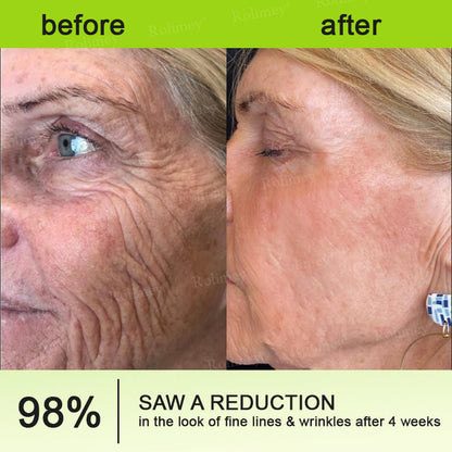 👨🏻‍⚕️ Made and shipped from the USA Rolimey® Botox & Vita-A Retinol Shot Wrinkle-Lift Tightening cream - Last Day Promotion 70% OFF
